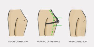 Ортез на клиновидную грудь Reh4Mat Carinatum AM-TX-04 детский